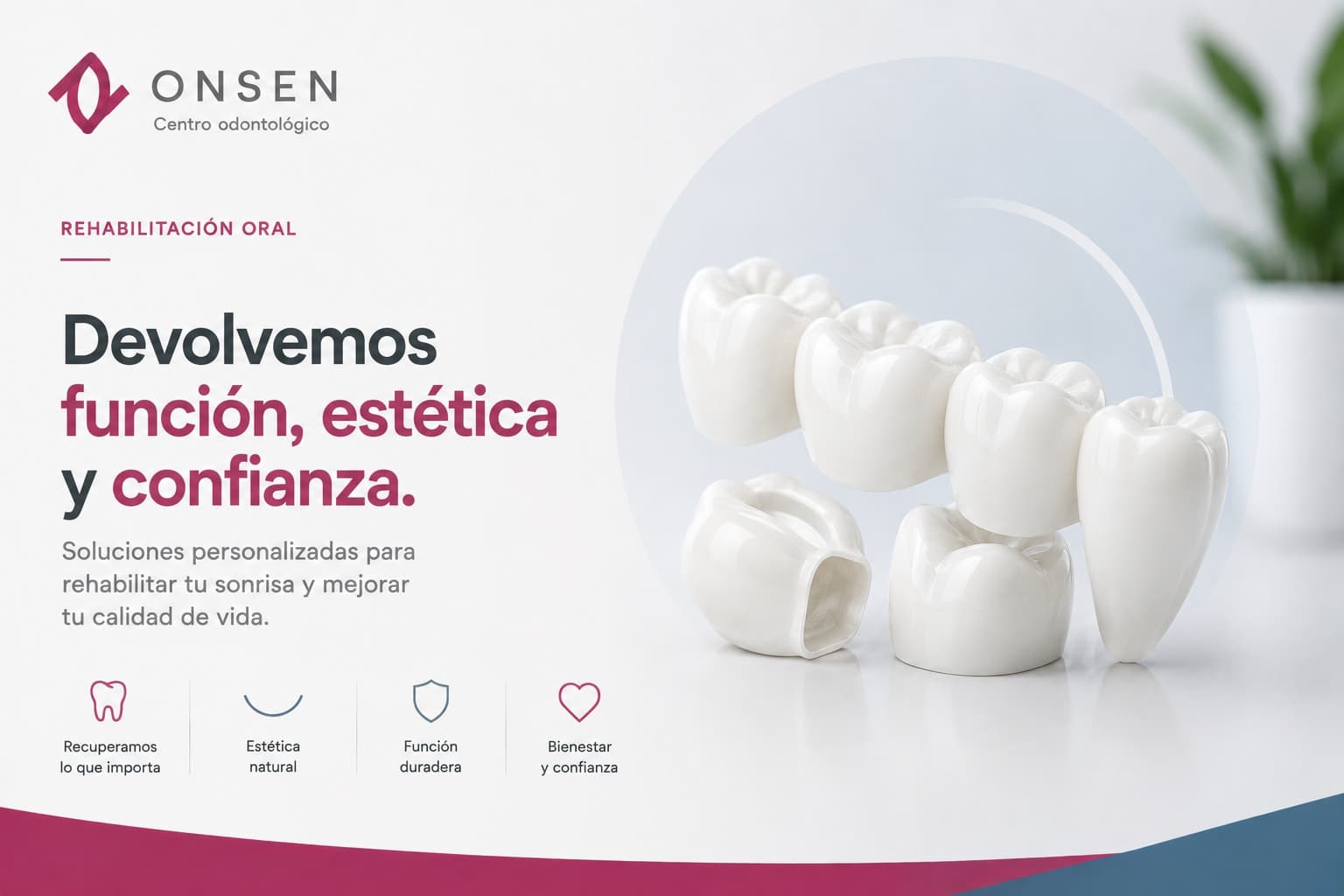 ¿Cuántos implantes necesito para tener dientes fijos?