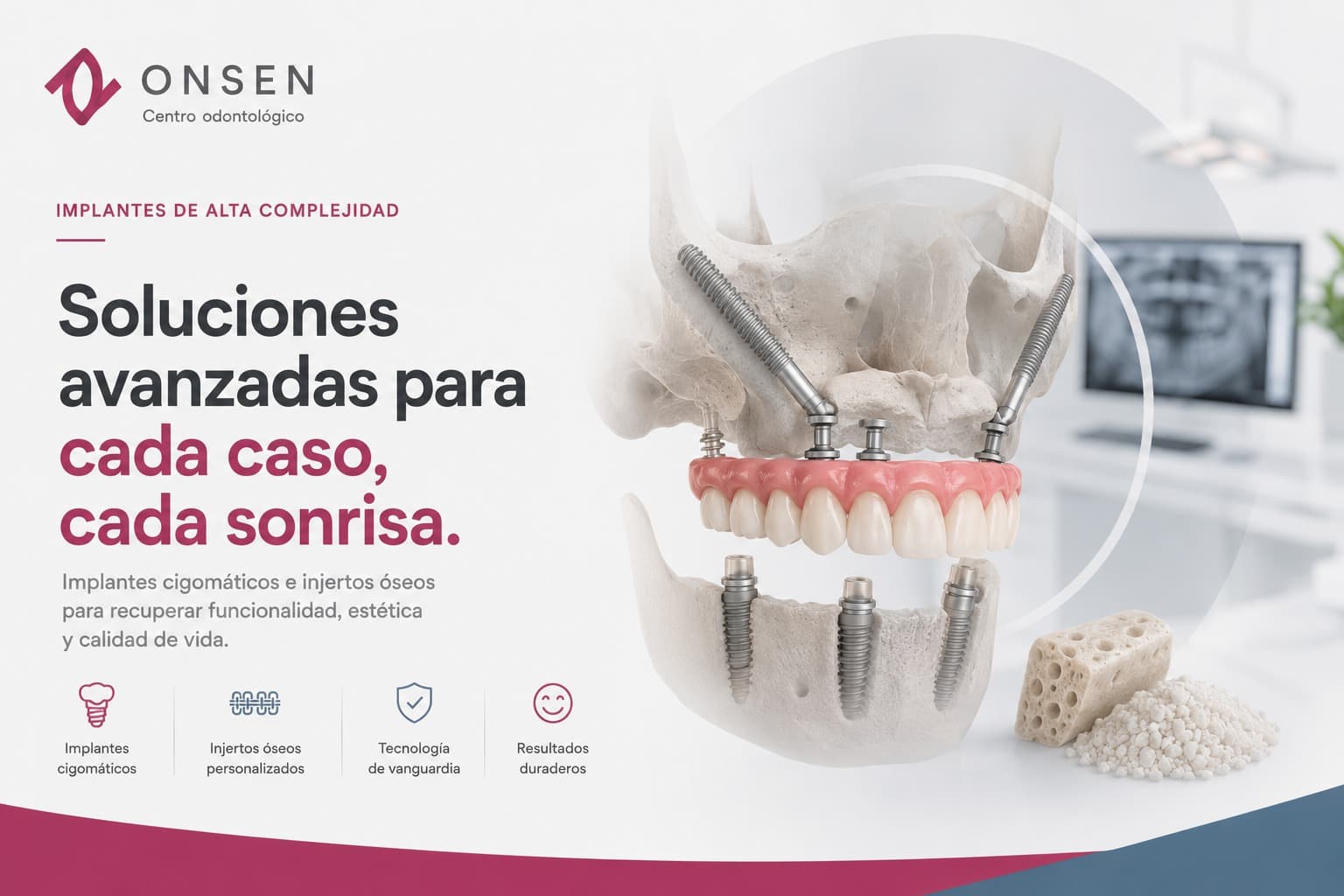¿Se pueden colocar implantes cuando existe pérdida ósea severa?